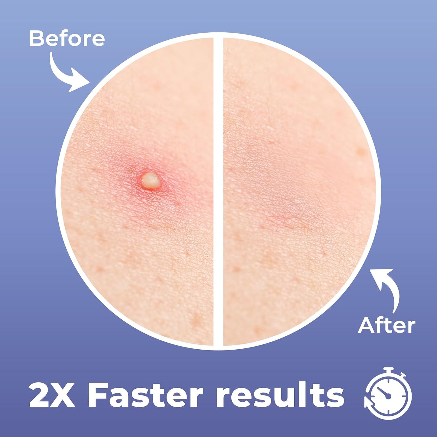 Pimple Patches (120 Pack)