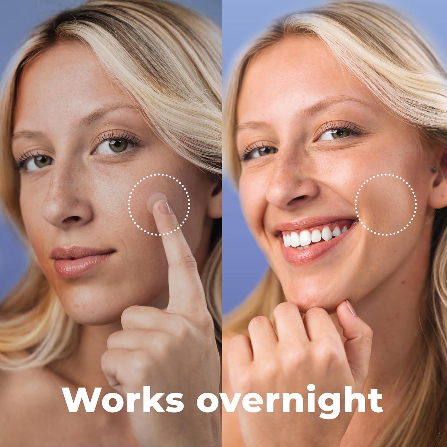 Pimple Patches (120 Pack)